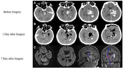 An endoscopic-assisted contralateral paramedian supracerebellar infratentorial approach in the treatment of thalamic hemorrhage with hematoma extension into the brainstem: a case report
